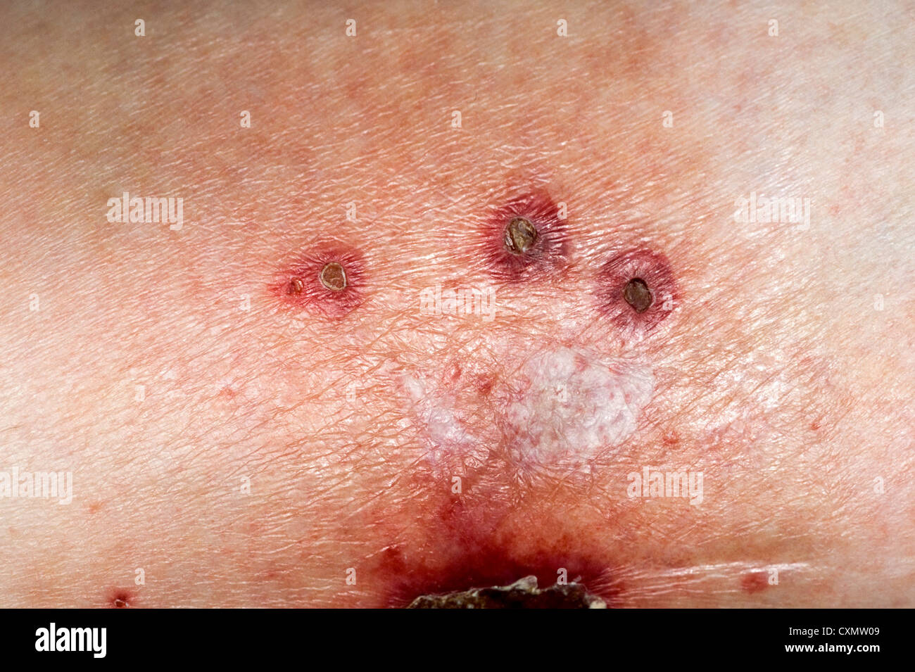 lesions on the leg due to vasculitis; small ulcerated lesions due to inflammation and necrosis of blood vessels Stock Photo