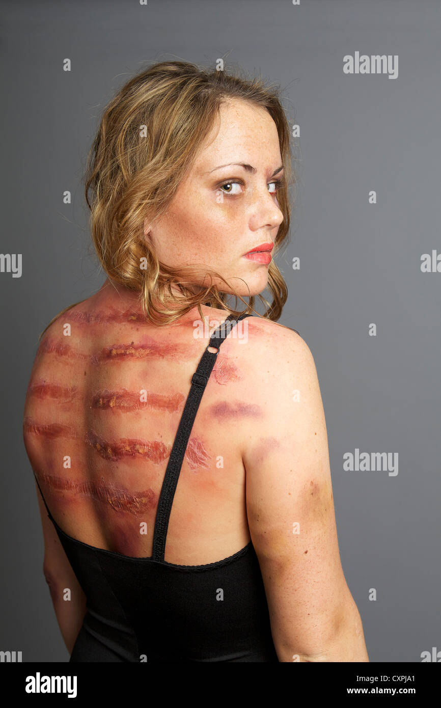 Young, girl, woman, female, model, caucasian, bruised, battered, beaten,  wounded Stock Photo - Alamy