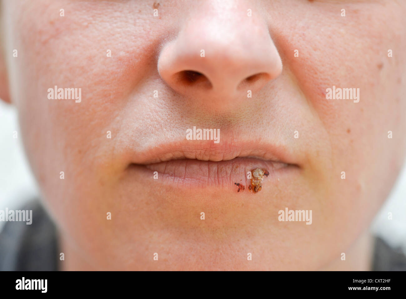 Woman with herpes simplex labialis on her lips Stock Photo Alamy