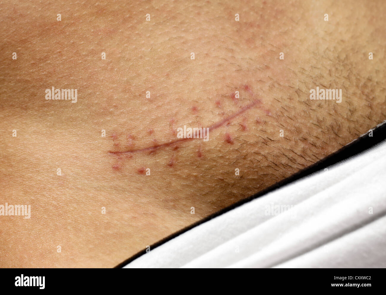 A man's scar after surgery, hernia inguinalis Stock Photo