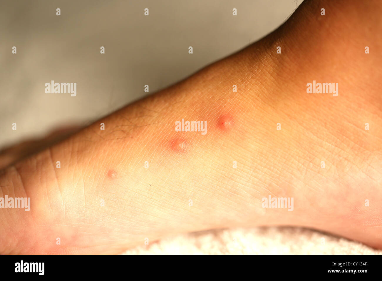 Bed Bug Bites Hi Res Stock Photography And Images Alamy