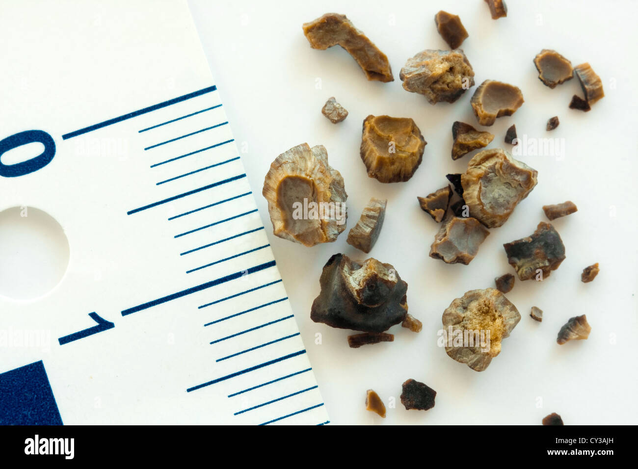 Kidney stones after ESWL intervention. Lithotripsy. Macro shot Stock Photo