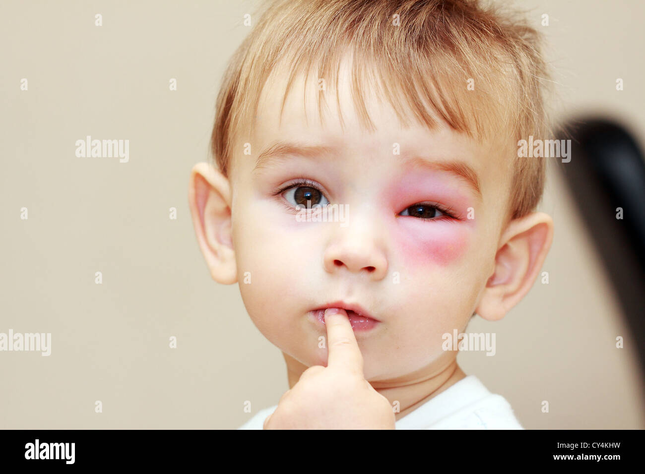 little boy - dangerous stings from wasps near the eye Stock Photo