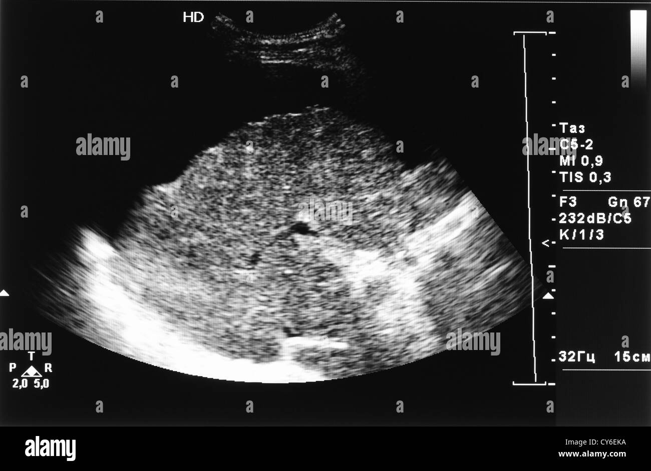 ultrasound image of liver cirrhosis and ascites Stock Photo