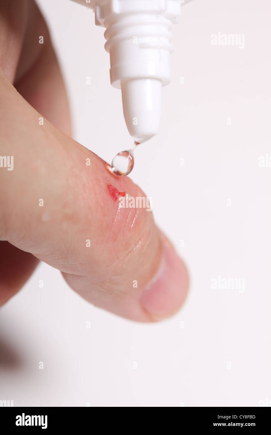 disinfect the scratch by rubbing in alcohol cuts on the hand Stock