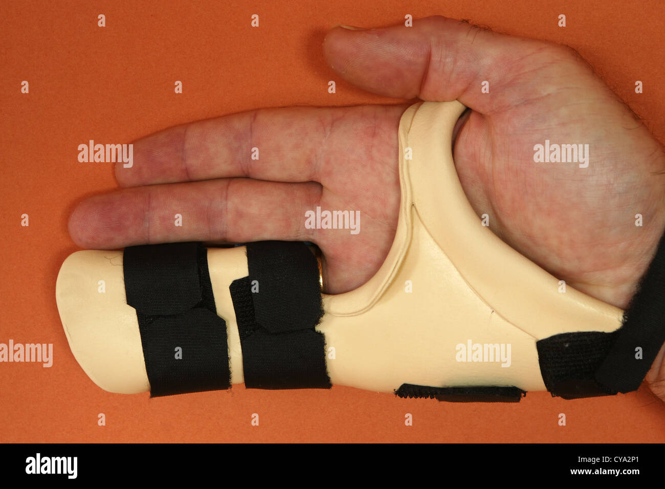 A patient wearing a hand splint after an operation to remove a