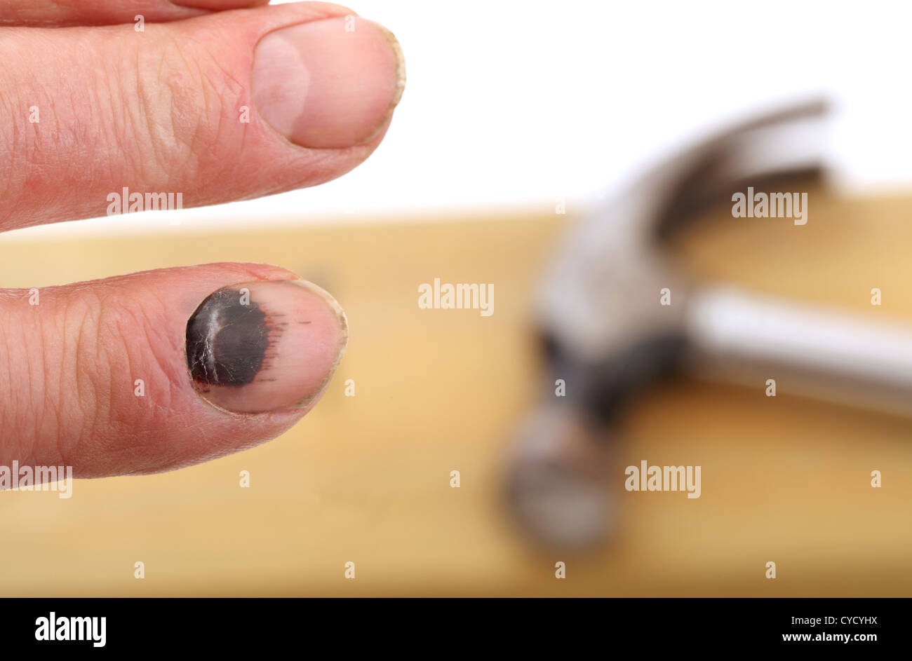 A mans black fingernail as a result of being hit with a hammer Stock