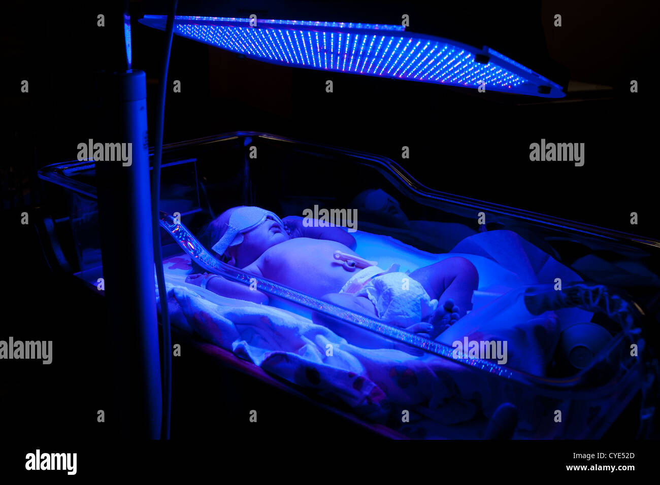 Newborn baby with neonatal jaundice and high bilirubin hyperbilirubinemia under blue UV light for phototheraphy. Stock Photo