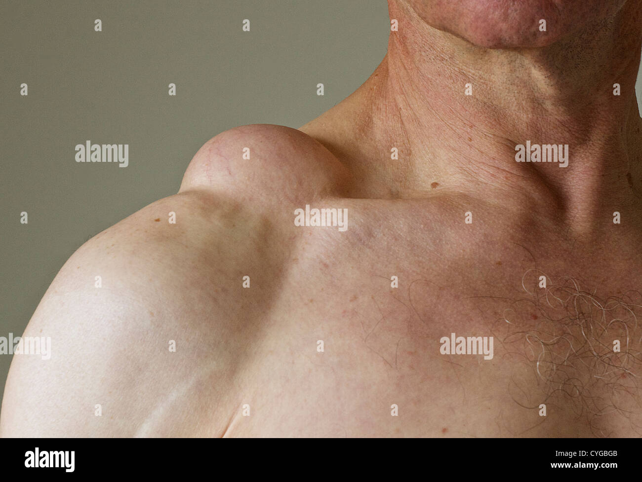 A lipoma on a male's shoulder. A lipoma is a benign tumour, or fatty lump, consisting of soft tissue, and is non-malignant. Stock Photo