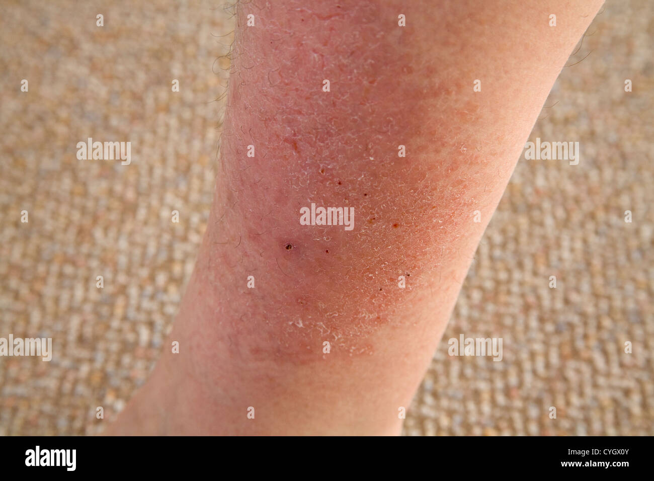 Close up large patch of eczema on a elderly woman's leg Stock Photo