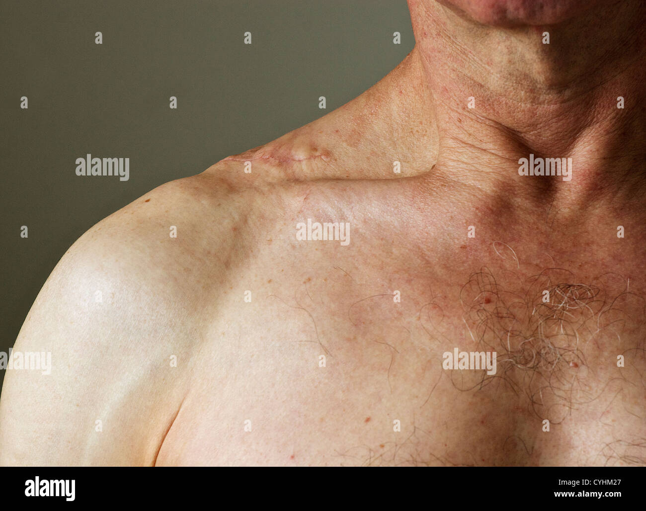 Scar on middle-aged male's shoulder from where a large lipoma has been surgically removed. Stock Photo