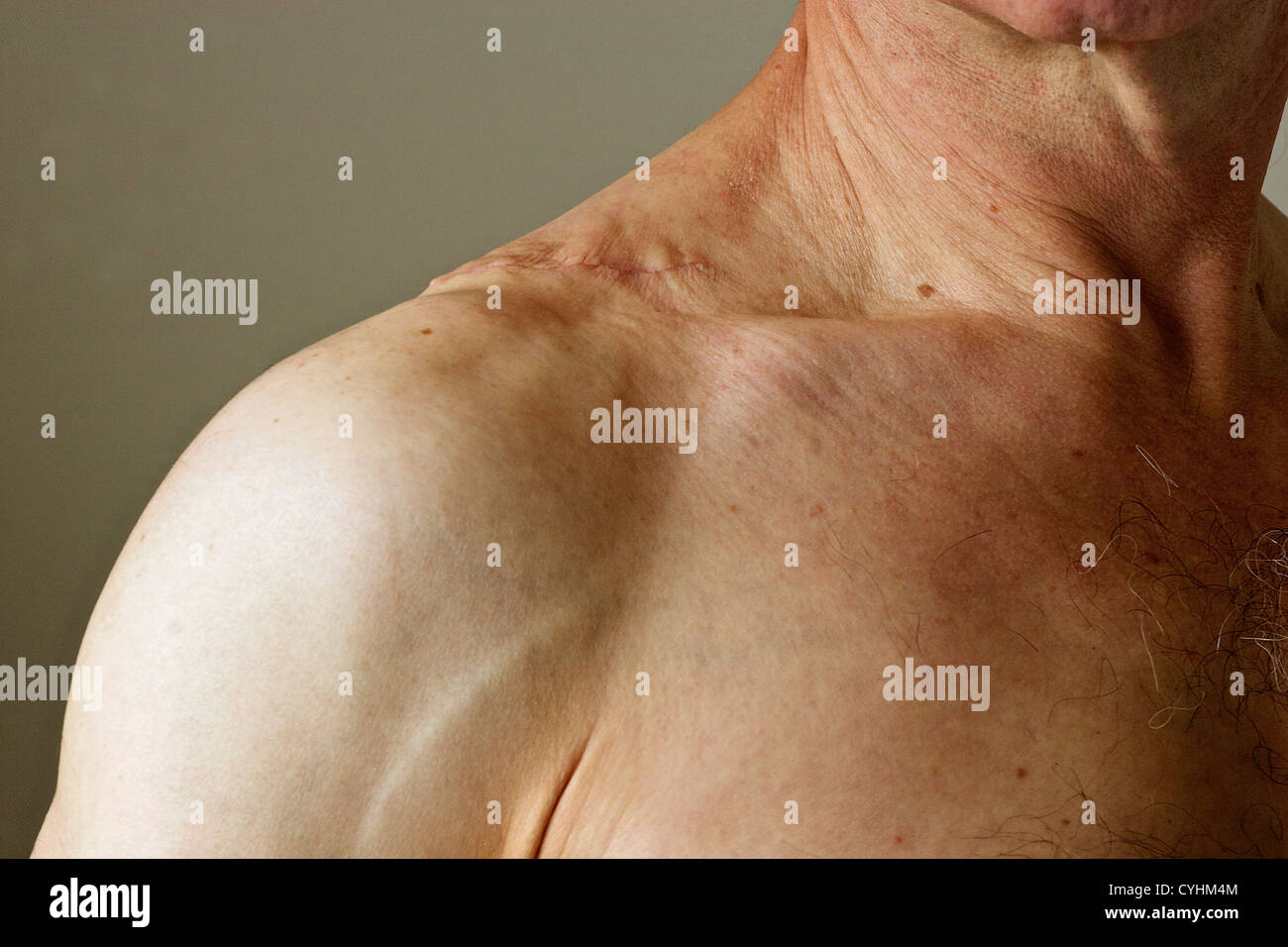Scar on middle-aged male's shoulder from where a large lipoma has been surgically removed. Stock Photo