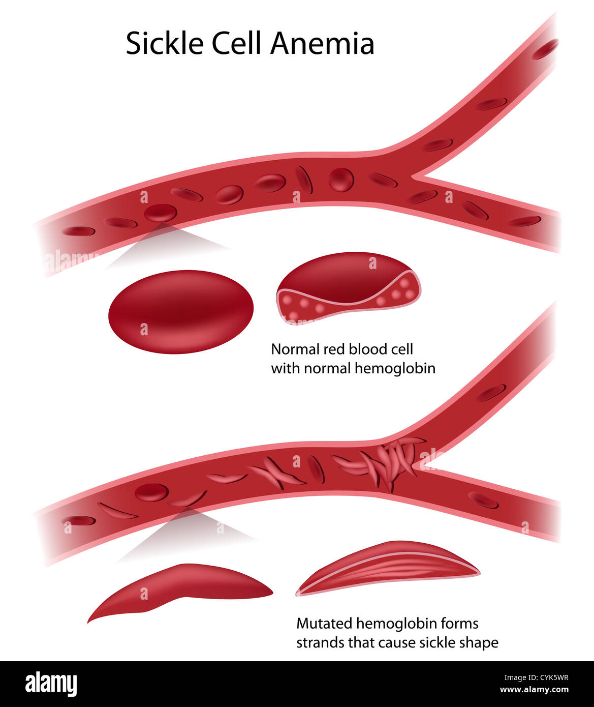 Sickle cell disease Stock Photo