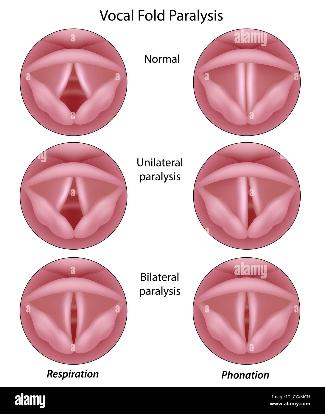 Vocal cord paralysis Stock Photo