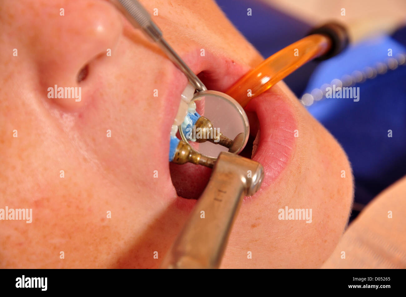 Photo of patient having his teeth healed Stock Photo - Alamy