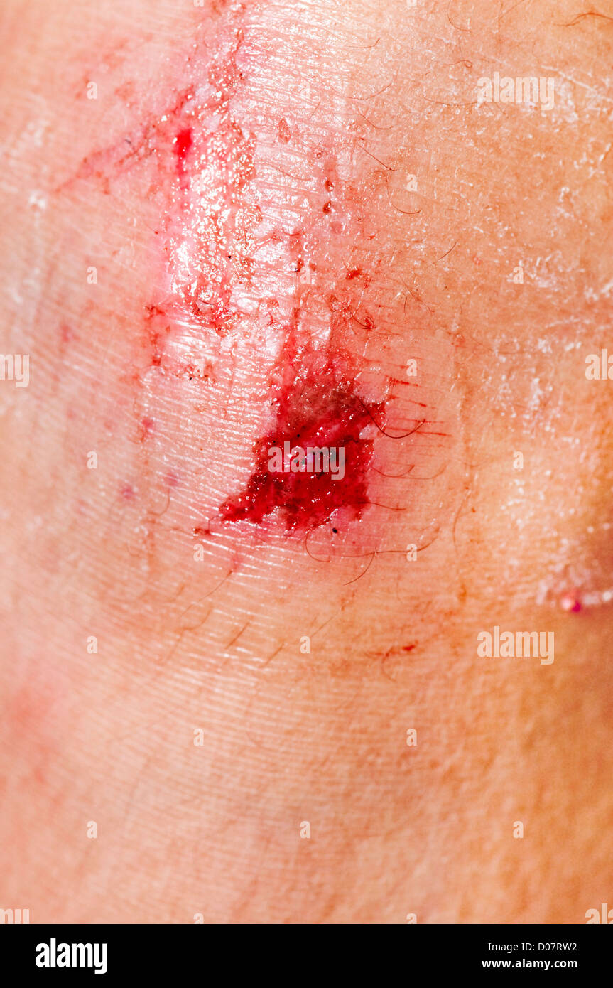 Girl with scraped knee hires stock photography and images Alamy