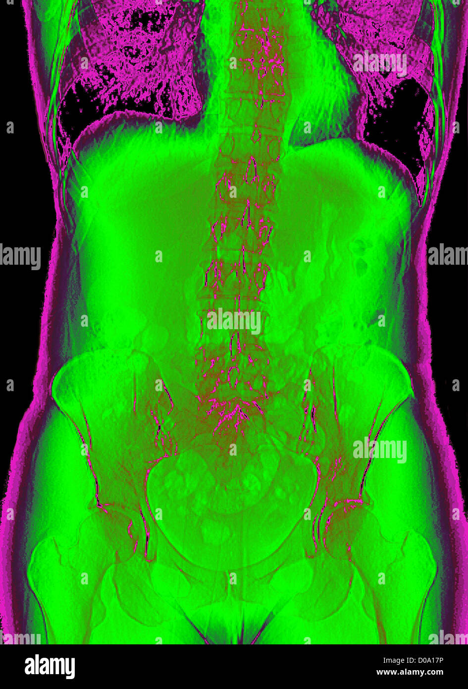 PELVIS, X-RAY Stock Photo