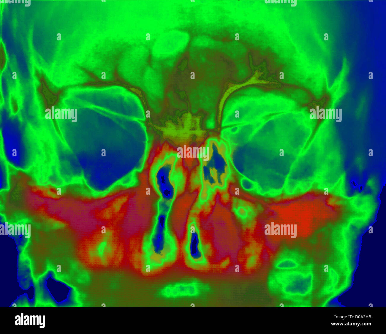 SINONASAL POLYPS Stock Photo