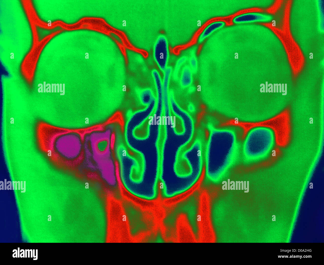 SINONASAL POLYPS Stock Photo