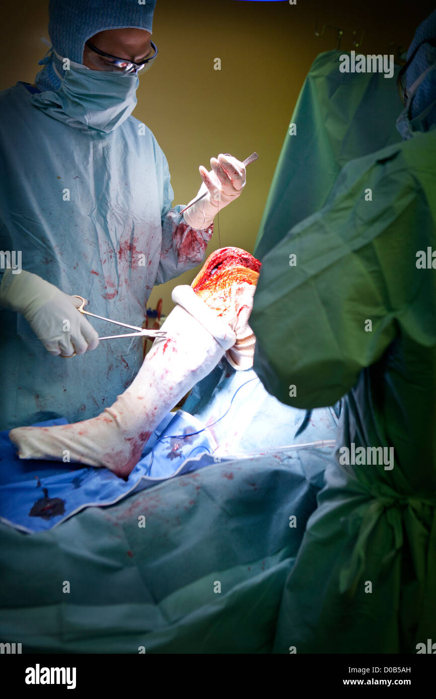 KNEE PROSTHESIS, SURGERY Stock Photo