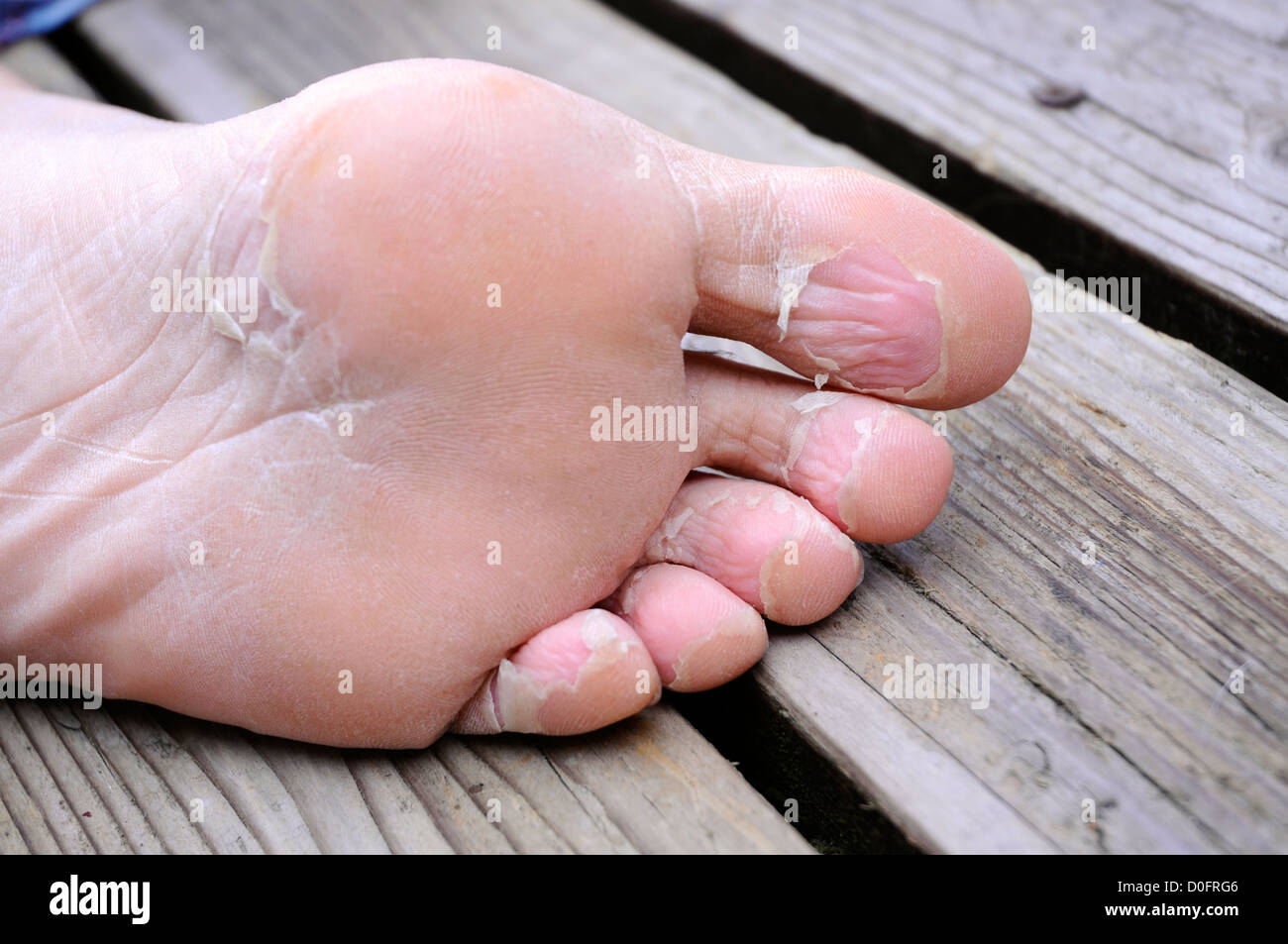 peeling foot with dead skin Stock Photo 