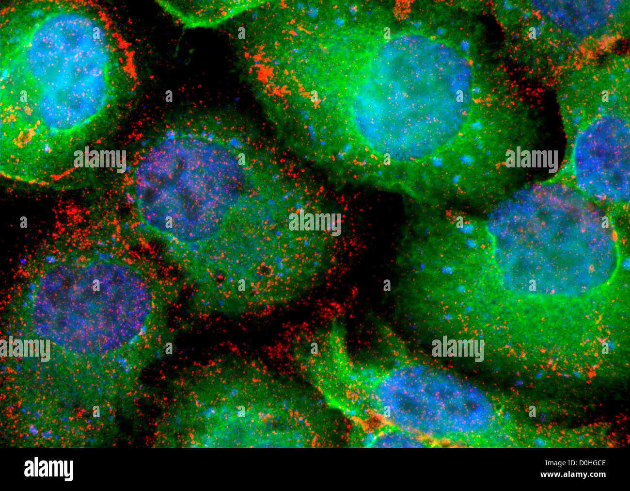 Supertough Cancer Cells, Microscopic View Stock Photo