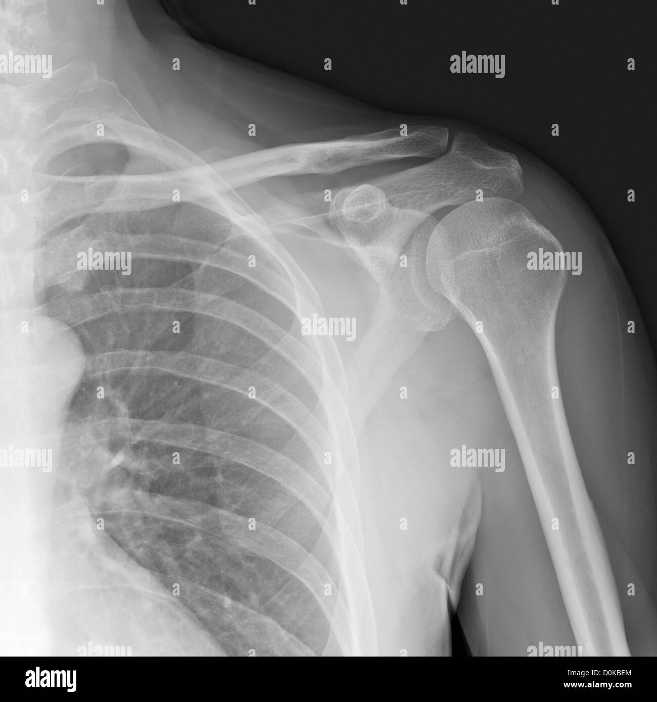 An x-ray human shoulder front showing humerus (the upper arm bone) shoulder  blade or scapula collarbone or clavicle rib cage Stock Photo - Alamy