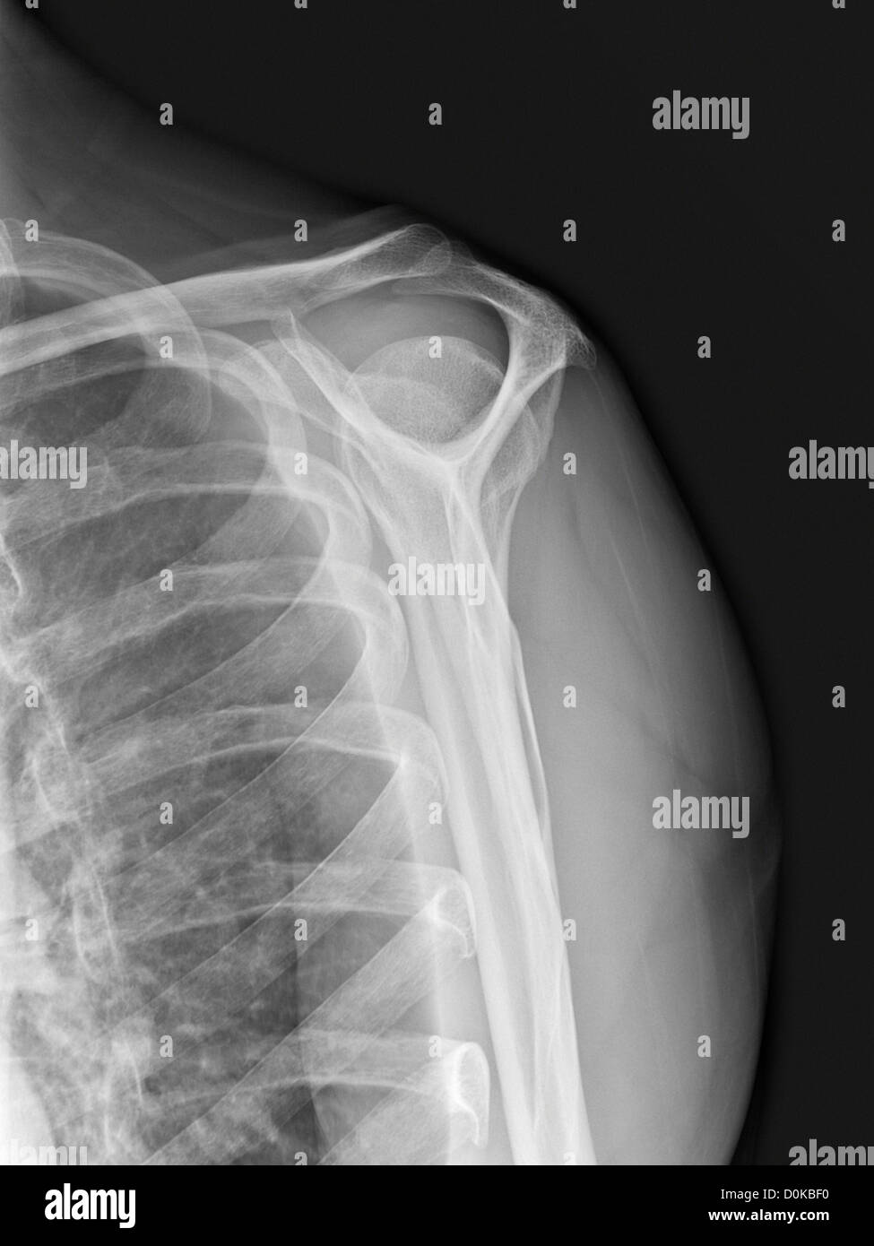An x-ray human shoulder front showing humerus (the upper arm bone) shoulder blade or scapula collarbone or clavicle rib cage. Stock Photo