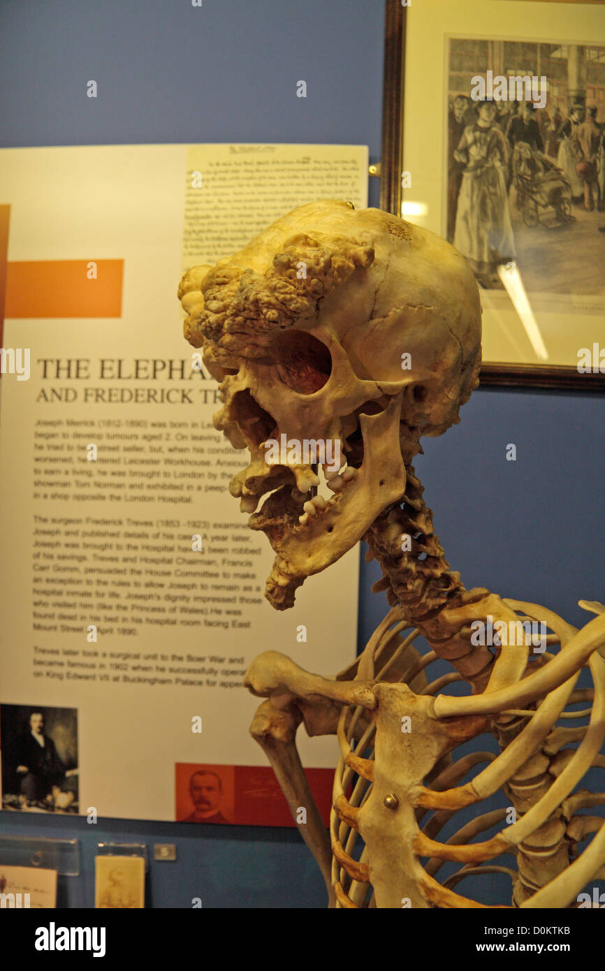 Replica of the skeleton of Joseph Merrick, the Elephant Man, The Royal London Hospital Museum, Whitechapel, London, UK. Stock Photo