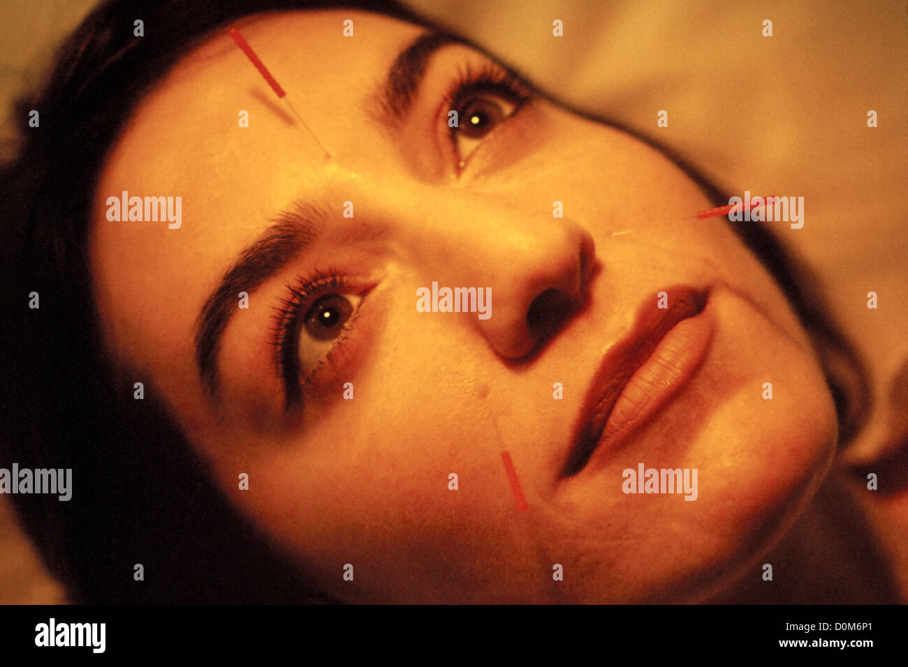 Patient with Acupuncture Needles in Face Stock Photo Alamy