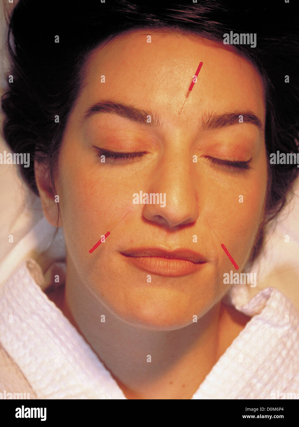 Patient Relaxing with Acupuncture Needles in Face Stock Photo Alamy