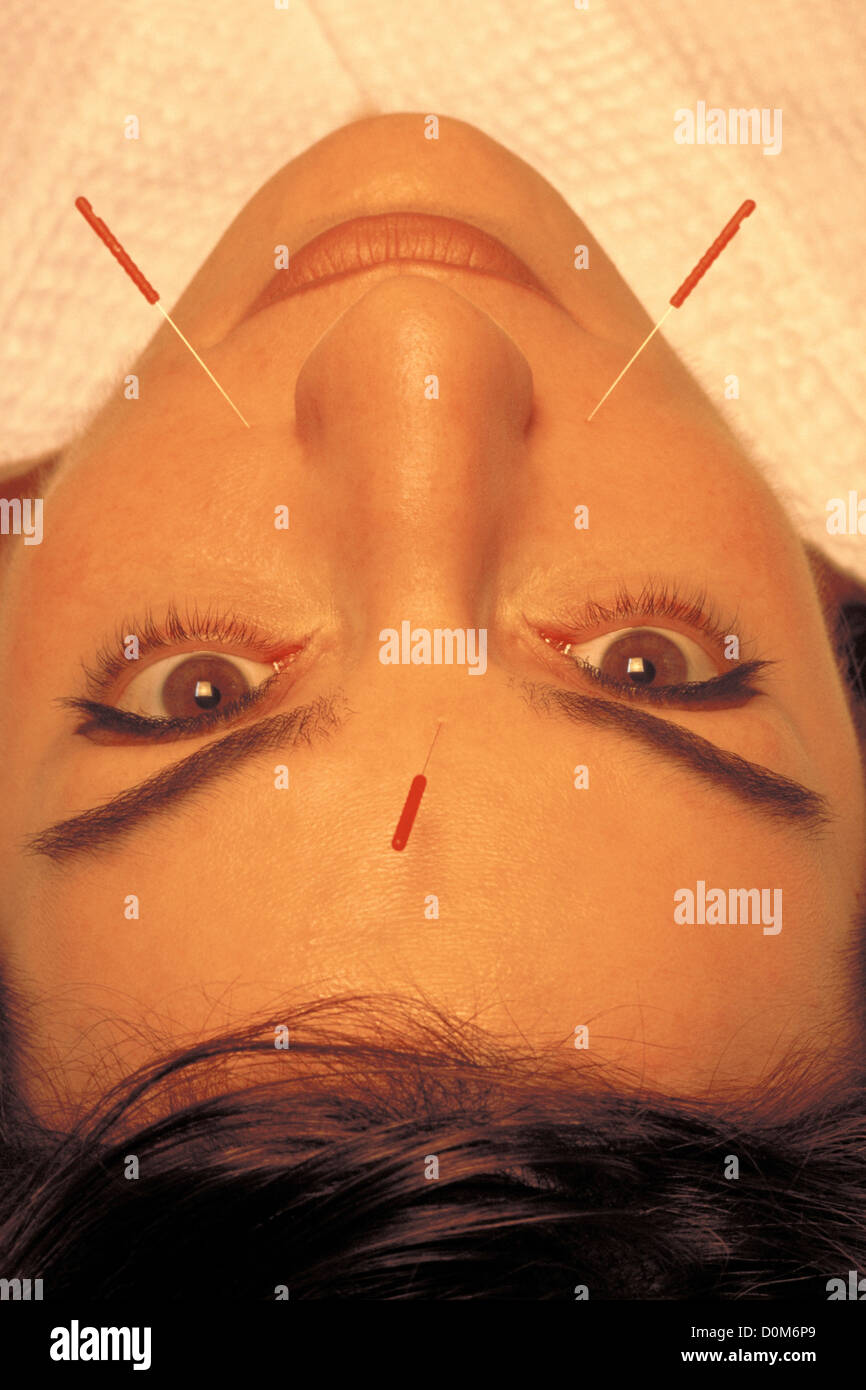 Patient with Acupuncture Needles in Face Stock Photo Alamy