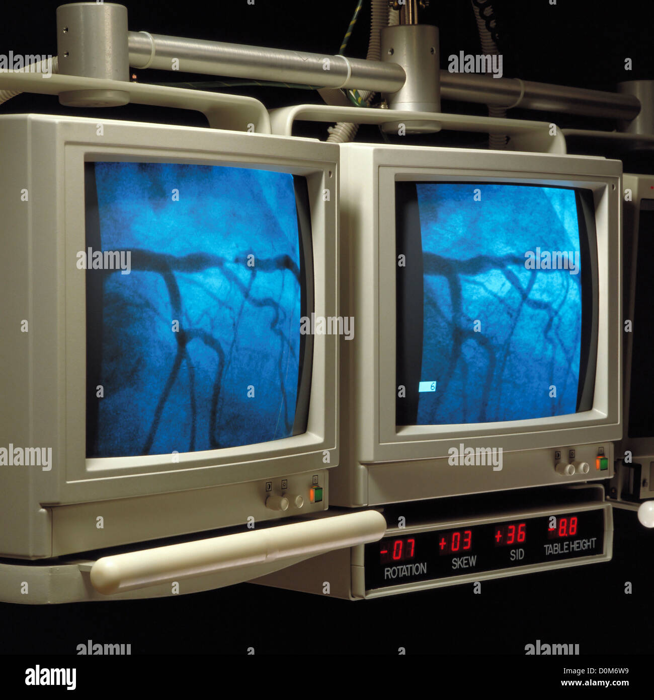 Video Monitors Displaying Heart During Cardiac Catherization Stock Photo