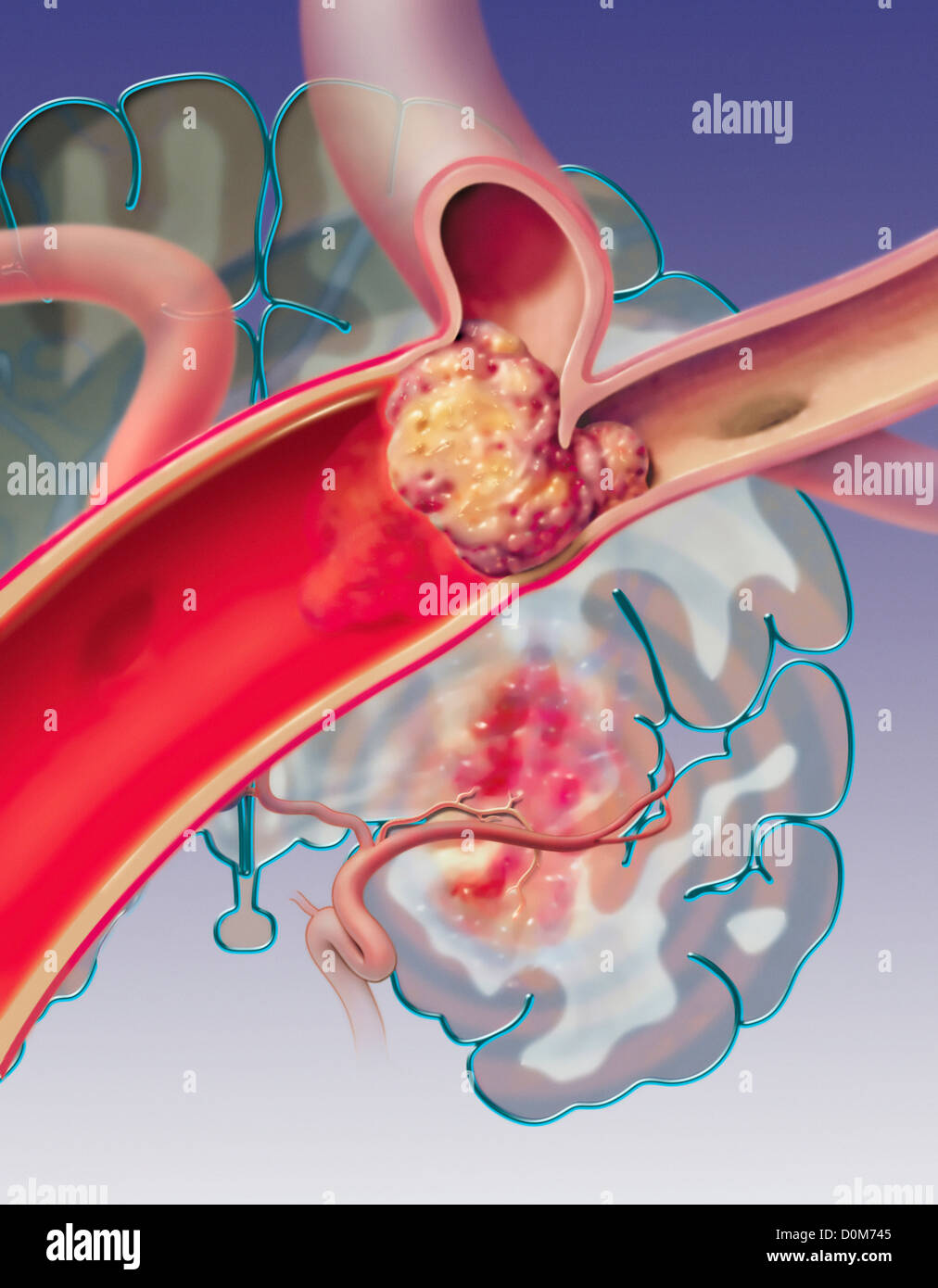 Illustration of a Cerebral Artery Blocked by a Blood Clot Stock Photo