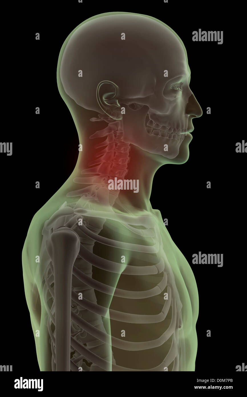 Side view of the bones of the head and neck. The cervical vertebrae are highlighted red to indicate pain or injury. Stock Photo