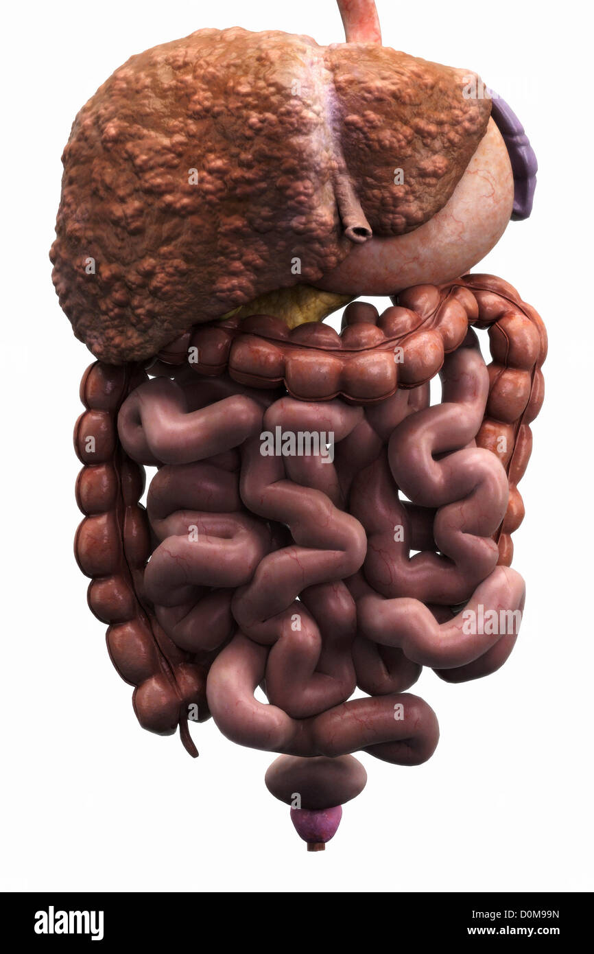 Front view organs digestive system. liver is displaying regenerative nodules which is symptomatic liver cirrhosis. Stock Photo