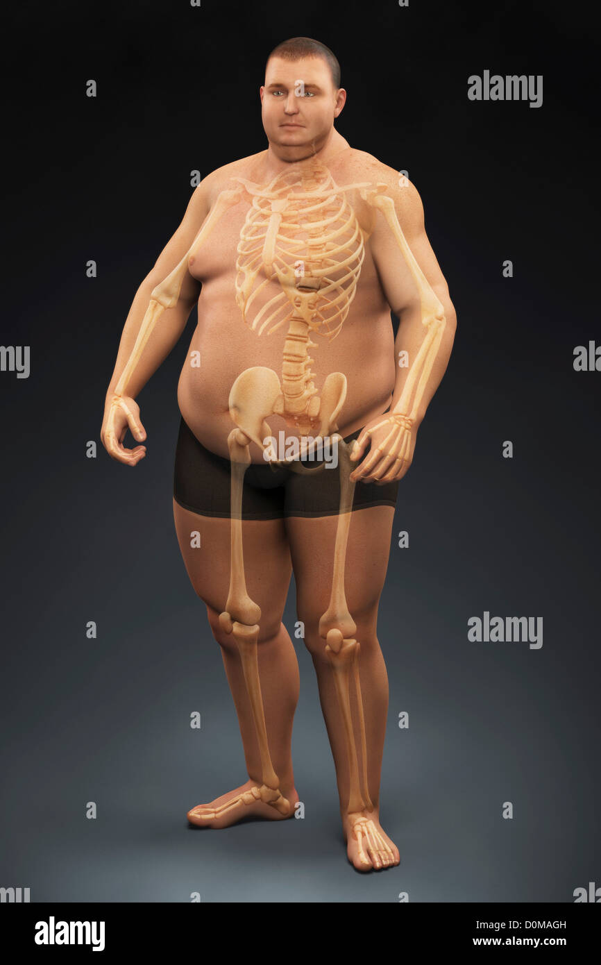 Human skeleton layered over man's body to reveal the severity of his overweight condition. Stock Photo