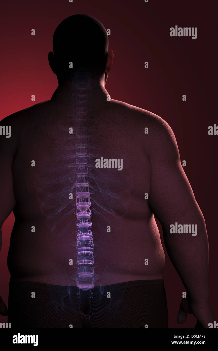 The skeletal structure of the spine and ribs layered over overweight man's back to reveal the impact of his condition. Stock Photo