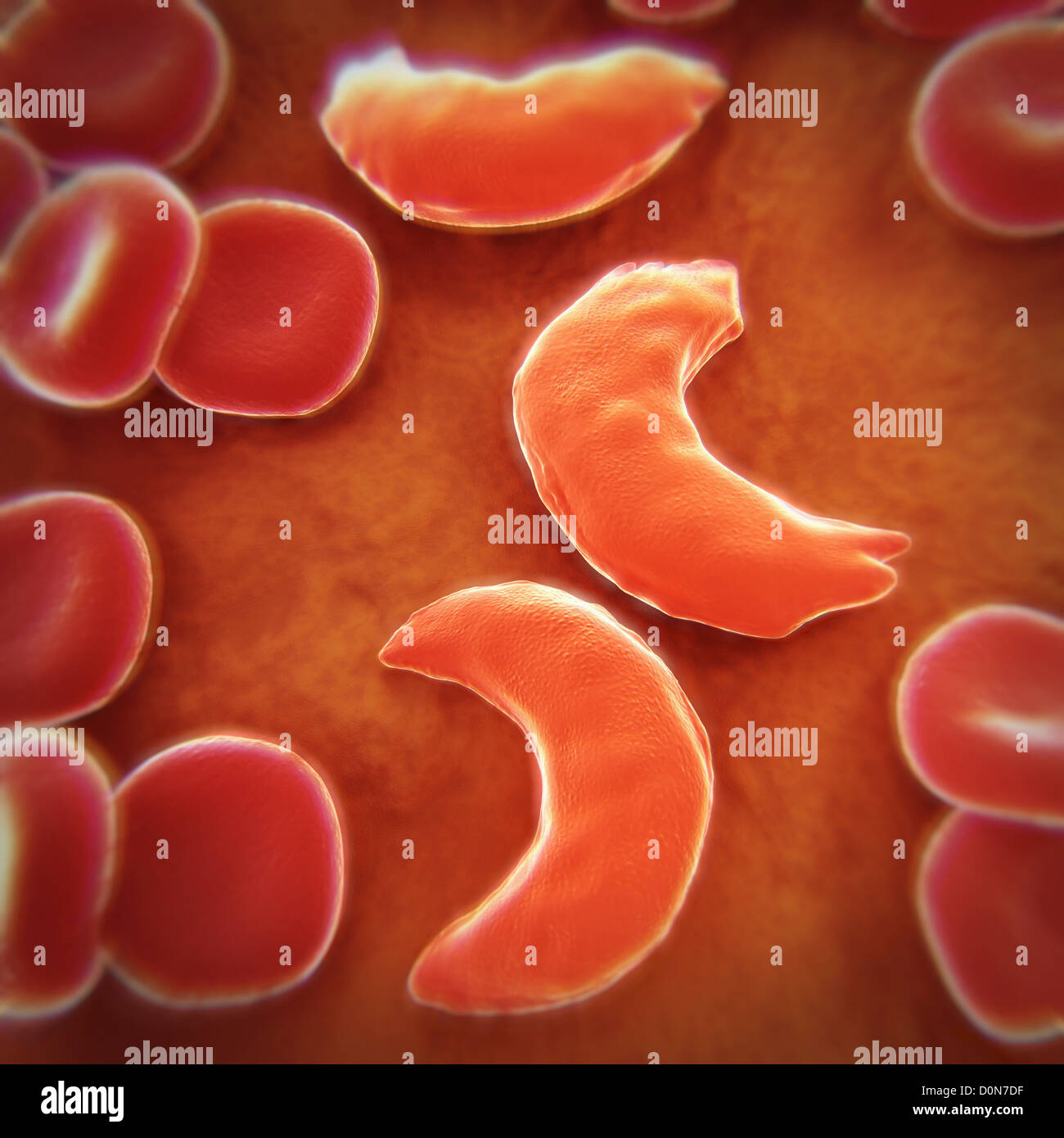 Sickle-cell disease sickle-cell anaemia or drepanocytosis is recessive genetic blood disorder characterized red blood cells Stock Photo