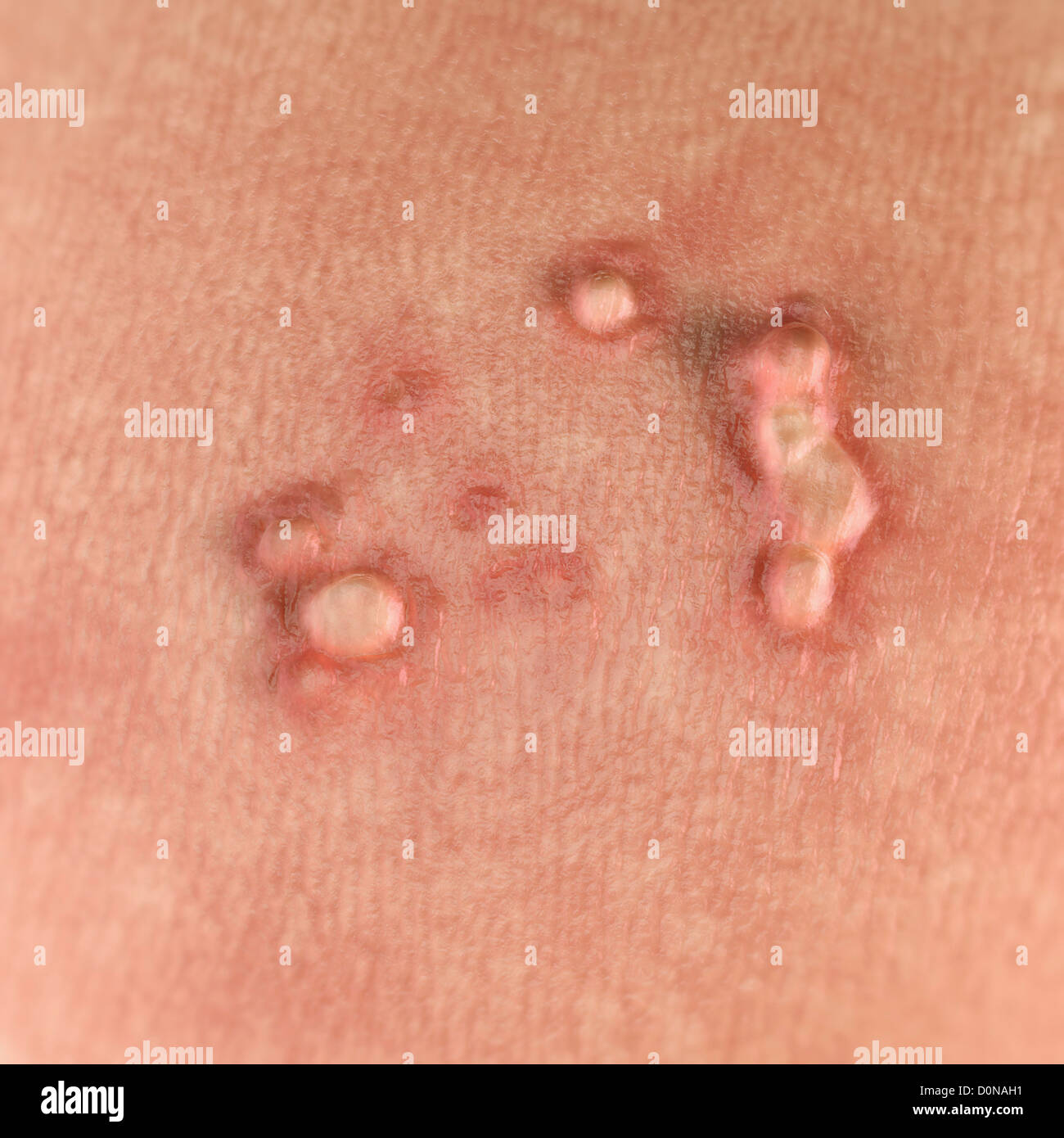Close up view of warts. Warts are caused by the human papilloma virus or HPV. Stock Photo