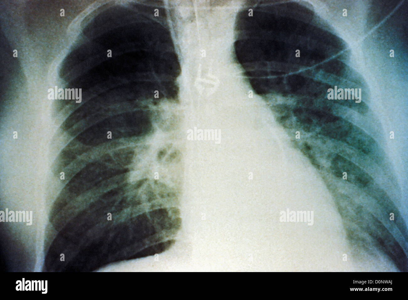 This chest xray reveals midstaged bilateral pulmonary effusion due