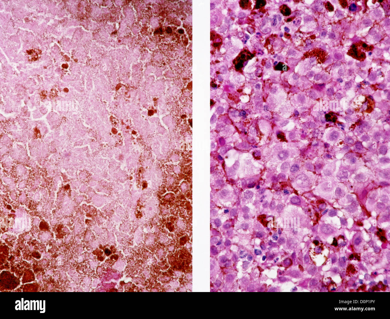 A histology 53 year old woman metastatic melanoma multiple subcutaneous sites retroperitoneum. She was treated tumor Stock Photo