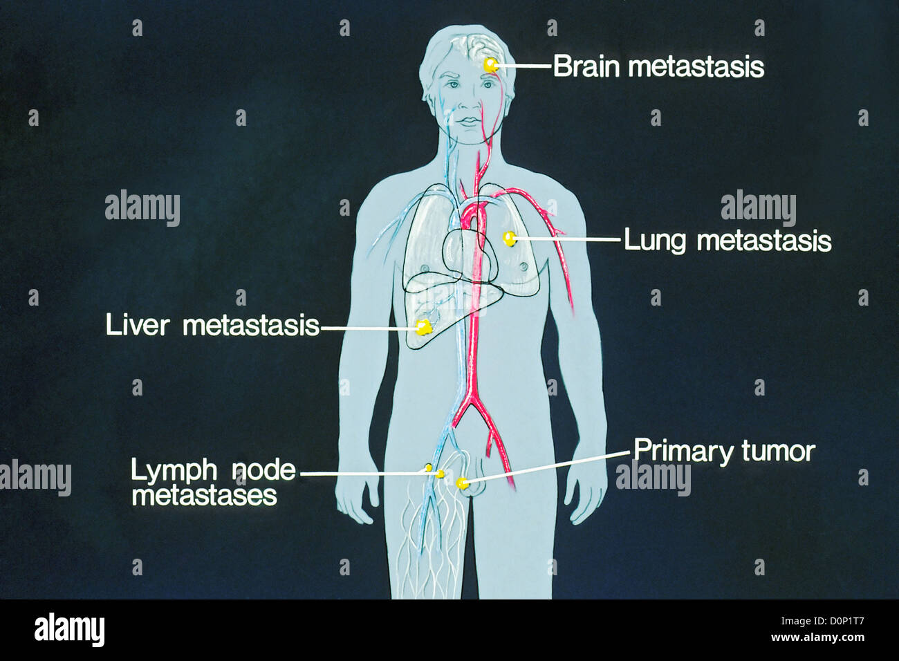 This is schematic drawing sites potential metastases places where ...