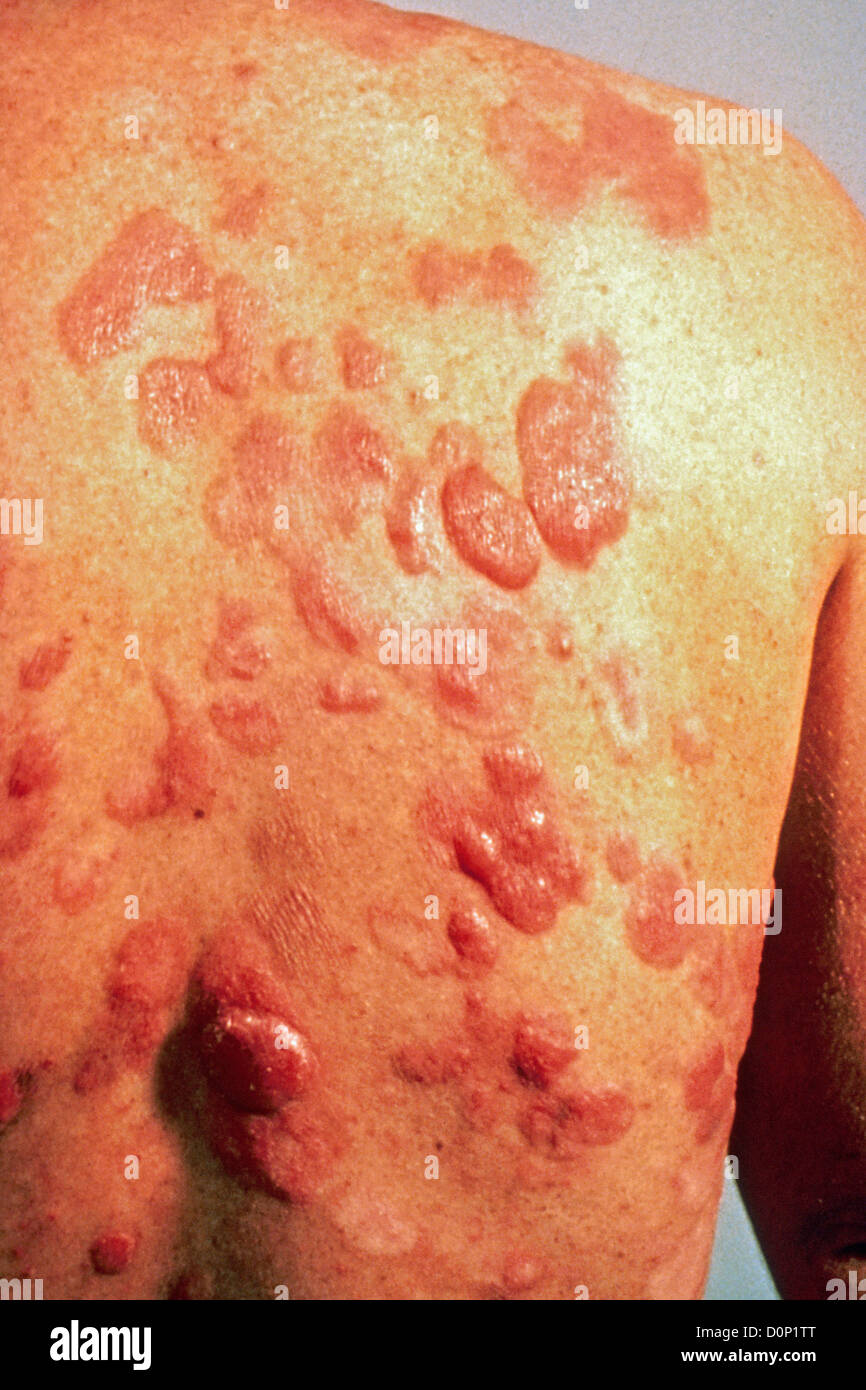 Kaposi's sarcoma are common opportunistic side-infection people HIV-AIDs It is cancer caused virus takes form lesions on skin. Stock Photo