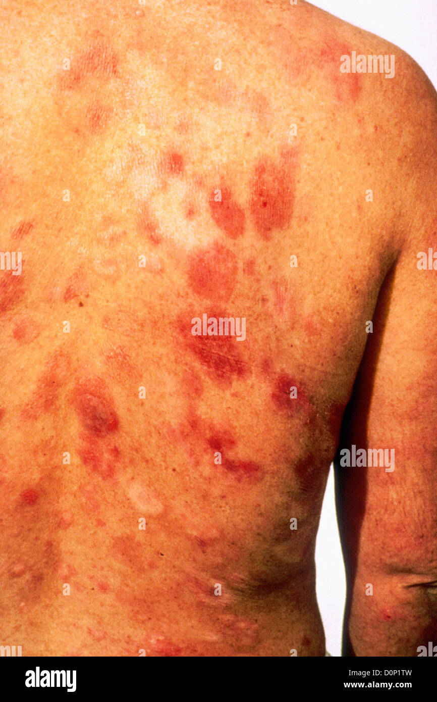Kaposi S Sarcoma Are Common Opportunistic Side Infection