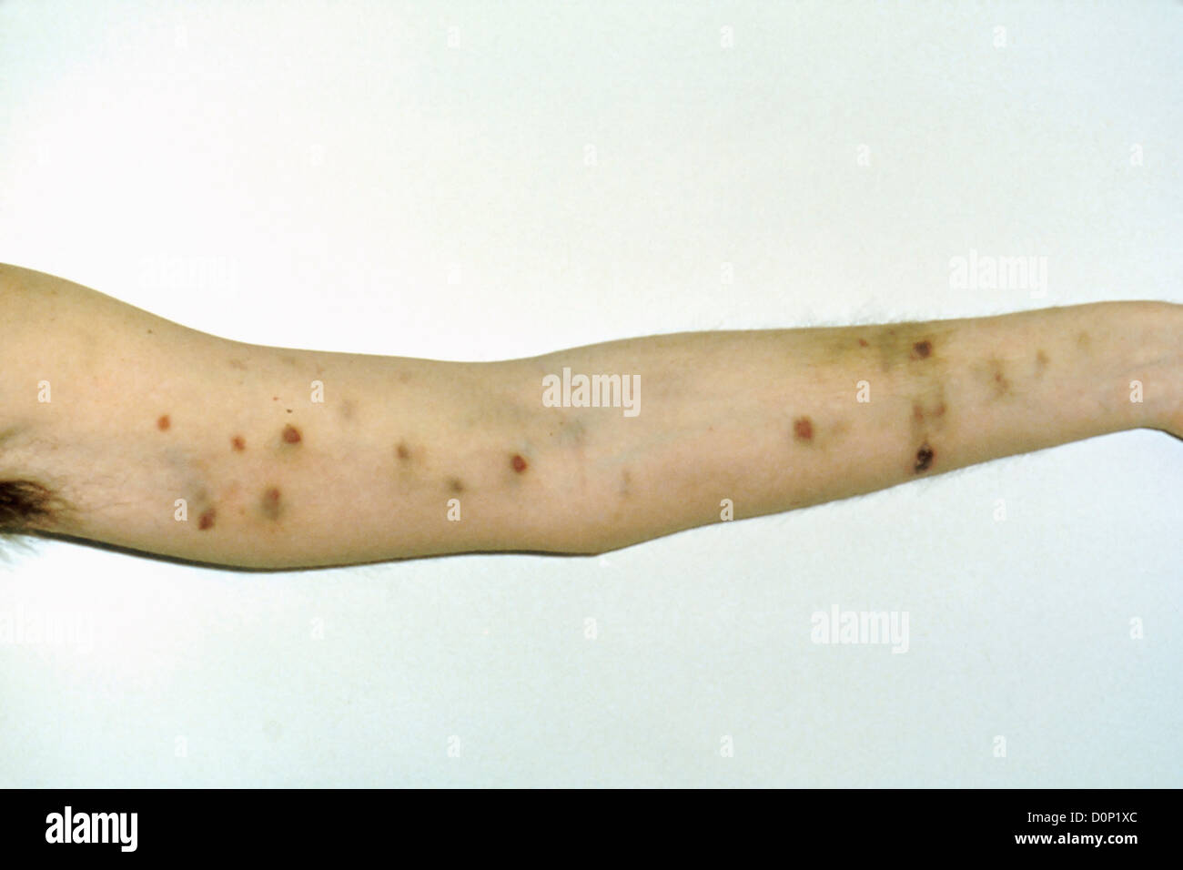 Kaposi's sarcoma on arm AIDS patient. Kaposi's sarcoma are common opportunistic side-infections people HIV-AIDs It is cancer Stock Photo