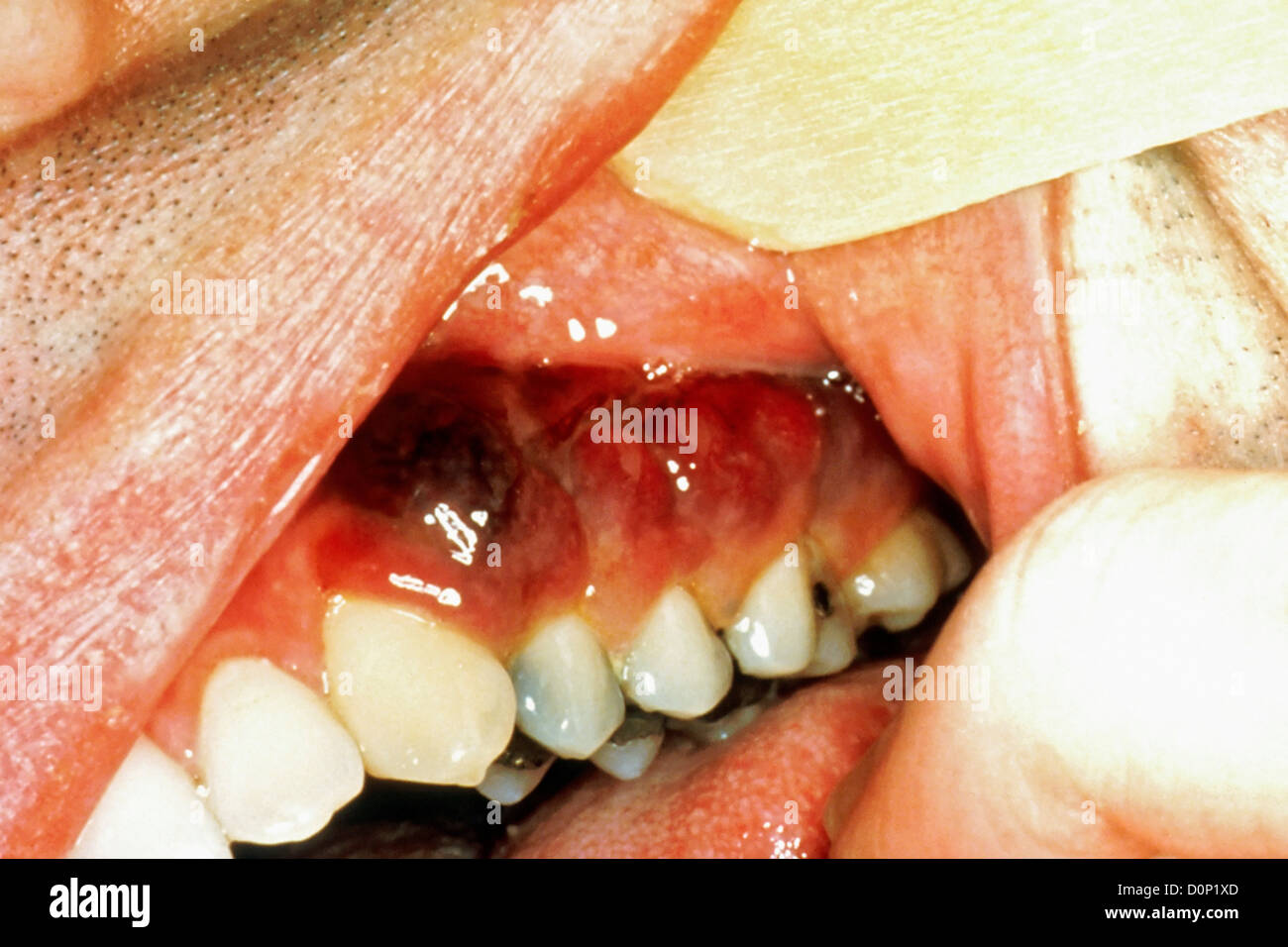 Kaposi's sarcoma in mouth AIDS patient. Kaposi's sarcoma are common opportunistic side-infections people HIV-AIDs It is cancer Stock Photo