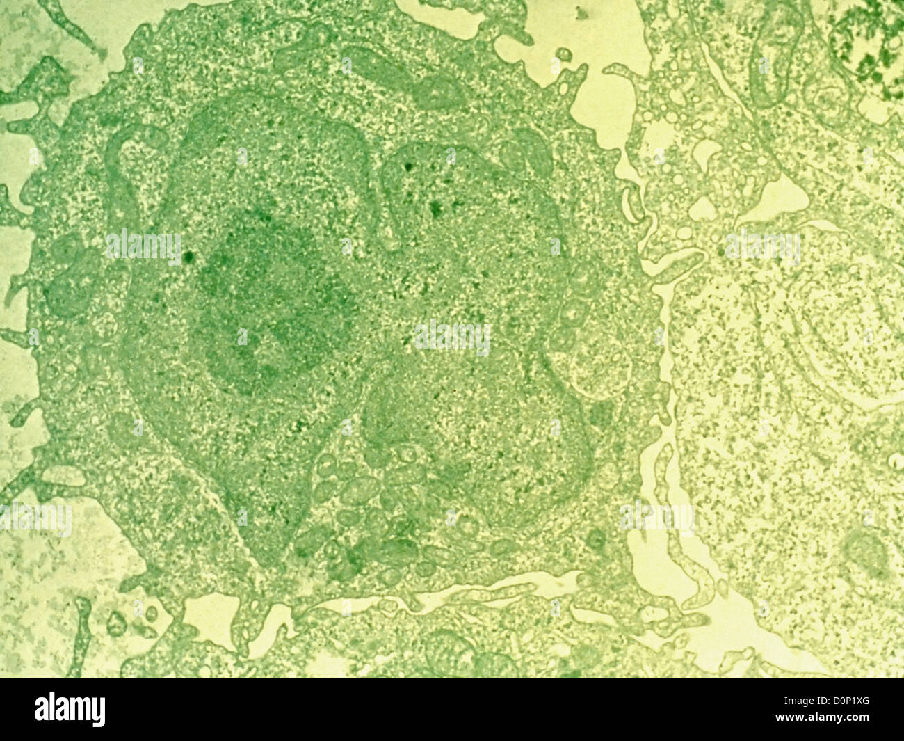 A histological slide of hairy cell leukemia. Stock Photo