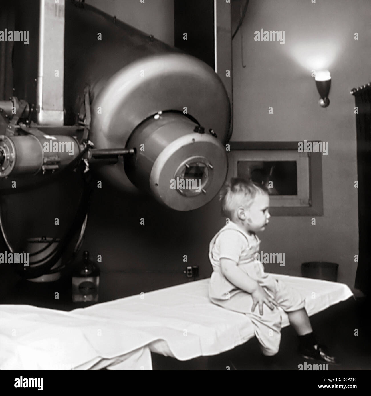 This is Gordon Isaacs first patient treated linear accelerator (radiation therapy) retinoblastoma in 1957. Gordon's right eye Stock Photo