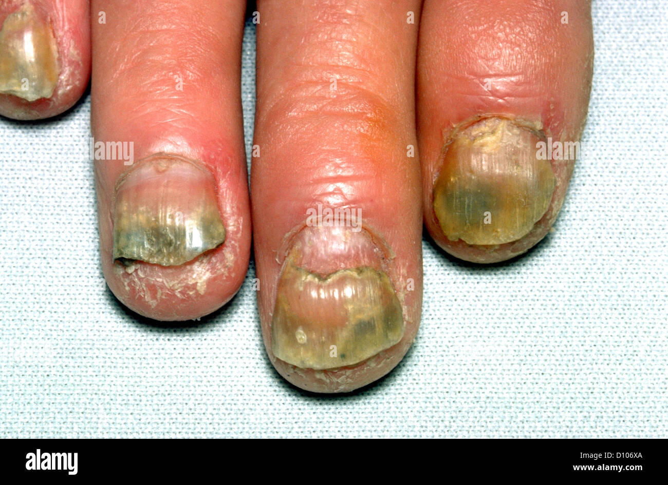 Psoriatic arthritis nails hires stock photography and images Alamy